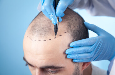 Patient suffering from hair loss in consultation with a doctor. Doctor using skin marker - obrazy, fototapety, plakaty