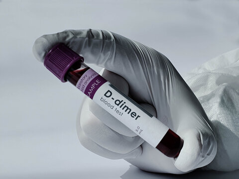 D-dimer blood test