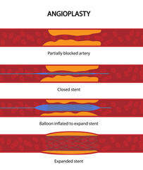 Balloon angioplasty procedure illustration. Step by Step the Stent insertion in a partially blocked artery