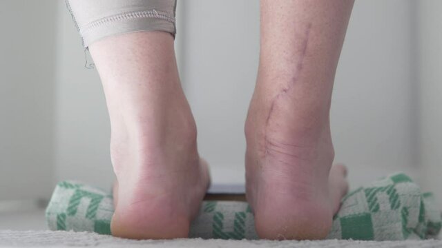 A woman with a scar on her leg stretches her achilles at home. Close-up of gymnastics, rise on socks and stretches down the heels.
