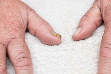 Nail fungus infection on the big finger. Fungal infection on nails hand, finger with...