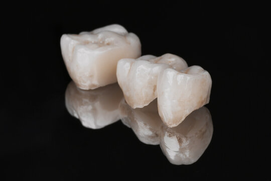Dental bridge of 3 molar teeth. Prosthetic dentistry. Tooth recovery with implant.  Close-up photo of metal free ceramic teeth crown isolated on black glass background