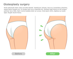Gluteoplasty surgery illustration before and after. Buttocks correction procedure with implantation.