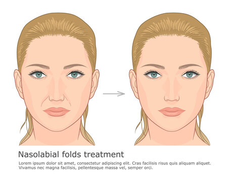 Nasolabial folds correction medical illustration. Treating deep nasolabial folds with facial filler.