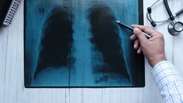 doctor hold analyzing xray photography, closeup
