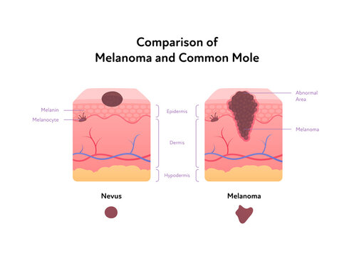 Melanoma cancer anatomical infographic poster. Vector flat medical illustration. Comparison of tumor and common mole with text. Design for healthcare, oncology, dermatology.