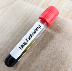 Blood sample for HBsAg confirmatory test. medical and health concept