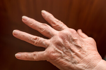 Fototapeta premium Hand of an elderly woman with signs of arthritis, joint disease