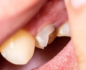 Chipped piece of a dead pulp tooth. Restoration of a damaged tooth in dentistry, defect in tooth...