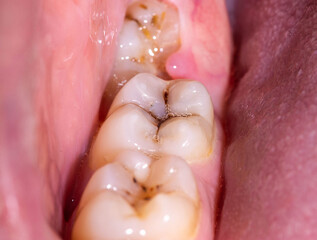 Caries in the mouth on the chewing teeth. Installation of high quality dental fillings. Dental...