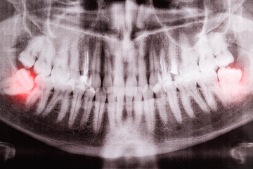 Impacted wisdom teeth on an X-ray picture with an inflamed cyst neoplasm. Removal of wisdom teeth in dentistry. Pericoronaritis