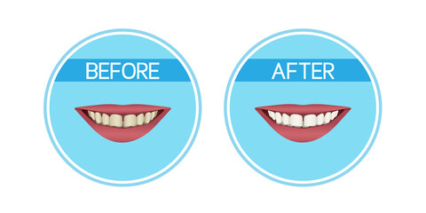 Teeth whitening: before and after. Yellow teeth and white teeth. Realistic vector illustration.