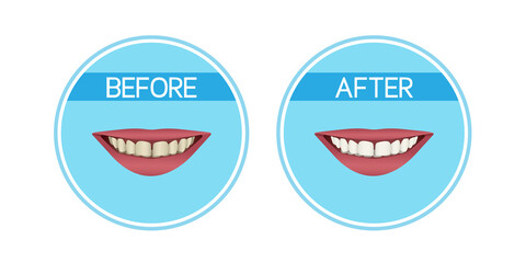 Fototapeta premium Teeth whitening: before and after. Yellow teeth and white teeth. Realistic vector illustration.