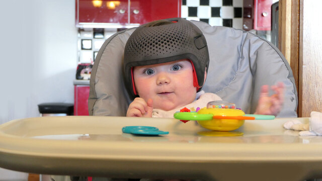 Baby Girl Wearing A Cranial Remoulding Helmet Flat Head