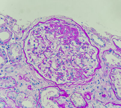Photo of glomerulus with segmental sclerosis, PAS stain, magnification 400x, photo under microscope