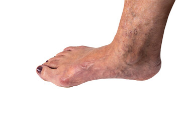 Hallux valgus, bunion on elderly woman's foot isolated on white background. Painful toe joint...