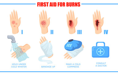 Ways of healing different skin burn injuries. Cartoon vector illustration. First aid methods for different degrees of skin burns. Treatment, first aid, fire concept for banner design or landing page - obrazy, fototapety, plakaty