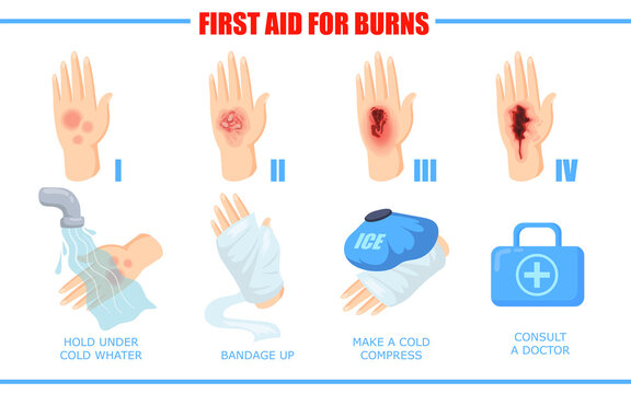 Ways of healing different skin burn injuries. Cartoon vector illustration. First aid methods for different degrees of skin burns. Treatment, first aid, fire concept for banner design or landing page
