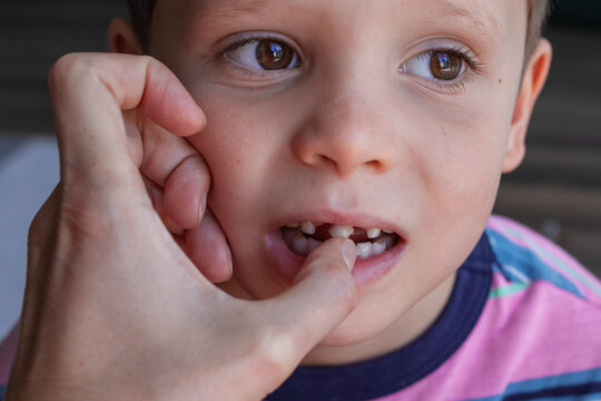 removing a baby tooth. Brave strong boy pulls out his own tooth. Loss of healthy baby teeth.
