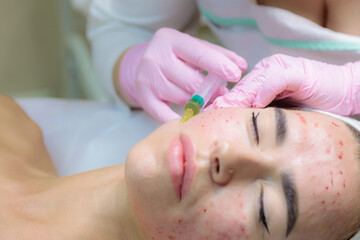 The doctor gives injections of blood plasma into the face of a young girl. Therapeutic procedure,...