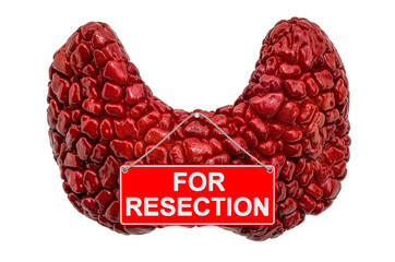 Thyroid with For Resection hanging sign, 3D rendering