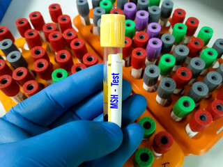 Blood sample tube for Melanocyte-Stimulating hormone (MSH) test with laboratory background.MSH is...