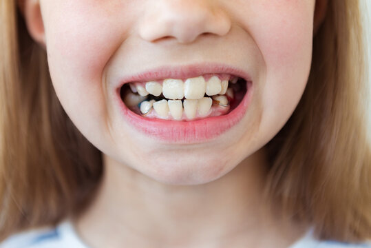 Child with removable orthodontic appliance in mouth. Concept of healthy teeth and a beautiful smile