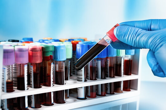Technician working with tray blood tubes samples for testing in the preanalytical lab. rack with tubes blood test from patients for analysis in the hematology laboratory