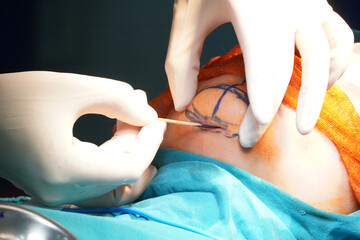Draw a line around the chin. 
Before performing chin augmentation surgery 