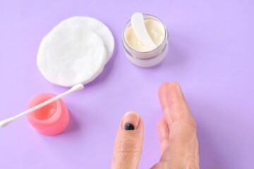 Injured finger on the hand with a hematoma under the nail on purple background with ointment and...