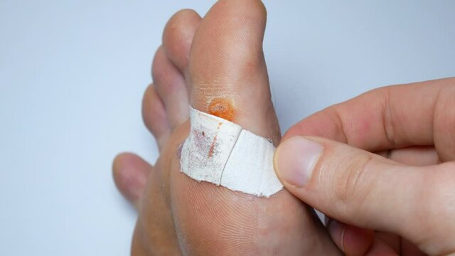 Contagious skin illness on foot. Medical treatment footage. Close up video of plantar wart on man's foot. Salicylic acid plaster. Remove Verruca plantaris.
