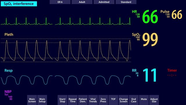 EKG monitor realistic animation loop, patient stable and resting