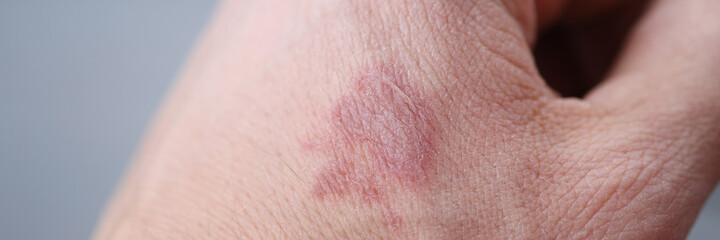 Fototapeta premium Closeup of burn stain on mans hand