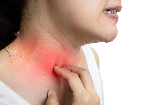Asian woman scratching an itchy area that is sweating from hot weather,an allergic reaction to sweat,red spots on the skin of the neck,rash,irritation of the skin,disease of allergy,atopic dermatitis