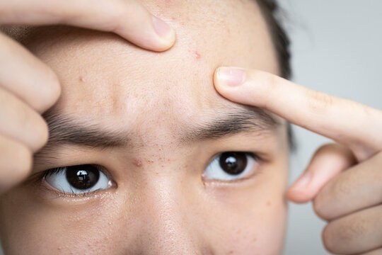 Asian teen girl squeezing pimples with fingers on her forehead,popping a pimple on face,a plug of sebum in a hair follicle causes acne,skin rejuvenation,acne treatment,beauty care and facial skin care
