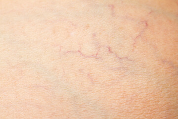 Varicose veins on a leg in Senior women, Close up & Macro shot, Selective focus, Asian body skin part, Healthcare concept