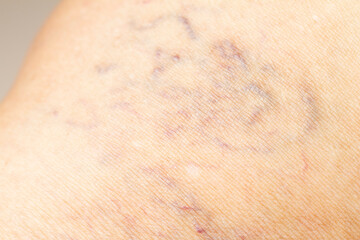 Fototapeta premium Varicose veins on a leg in Senior women, Close up & Macro shot, Selective focus, Asian body skin part, Healthcare concept