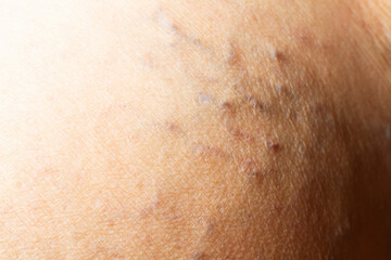 Varicose veins on a leg in Senior women, Close up & Macro shot, Selective focus, Asian body skin part, Healthcare concept