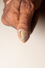Fungus Infection on Nails of old woman's thumb.