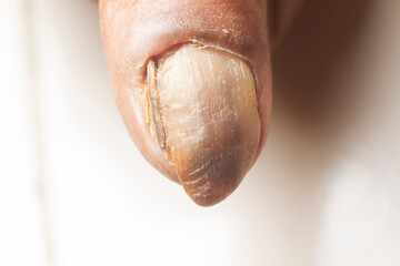 Fungus Infection on Nails of old woman's thumb.