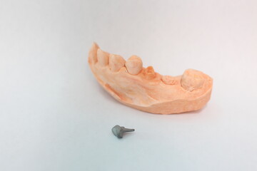 PFM post and core for crowns or bridge on top