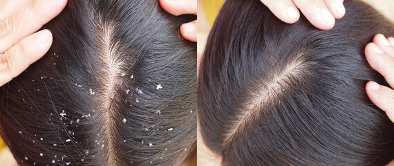 Image before and after dandruff treatment shampoo on hair woman. Problem health care concept.  - obrazy, fototapety, plakaty