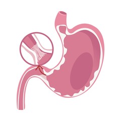 Obraz premium Illustration of Pyloric Stenosis disease