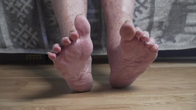 Sore toenails closeup unrecognizable person, old man. A poor woman's human feet look scary and horrible with long, uncut nails. Wrinkled spotted legs senior female