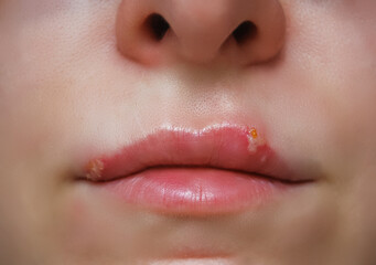 Macro photo of lips on woman's face with virus herpes.