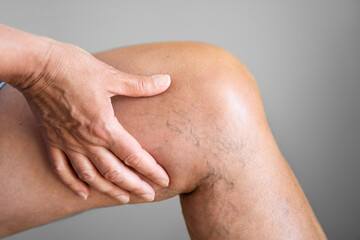 Leg Vein Varicose Disease And Pain