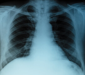 X-RAY scan of the human rib cage. Medical diagnostics.