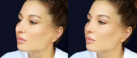 Rhinoplasty,septoplasty. Before and after correction