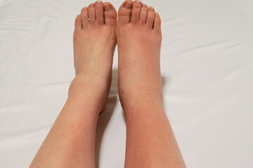 足の甲からふくらはぎにかけて現れた蜂窩織炎（蜂巣炎）の初期症状