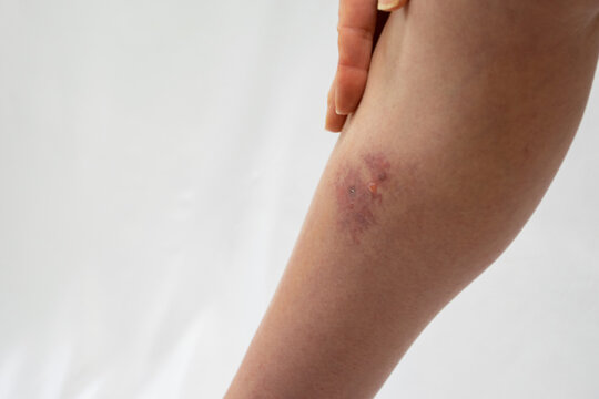 蜂窩織炎（蜂巣炎）の症状が出ている足のふくらはぎ内側